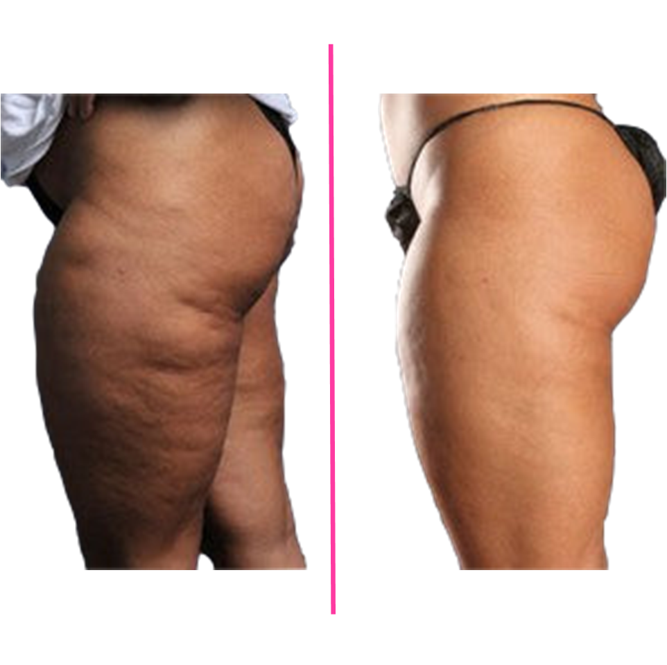 Cellulite Reduction - 1 session